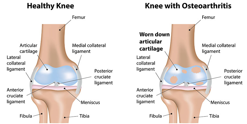 Osteoarthritis