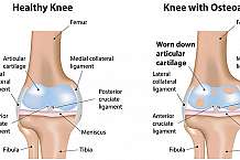 Osteoarthritis Its Not All Doom and Gloom